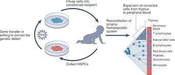 First gene treatment approved in the US for kids with rare genetic diseases